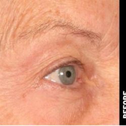 Ultherapy Before & After Patient #1553